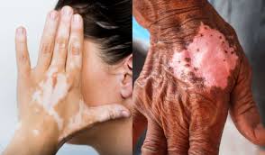 जिल्ह्यात कुष्ठ रुग्ण शोध अभियान यशस्वी;९६ टक्के लोकसंख्येची तपासणी,७ नवीन रुग्णांचे निदान